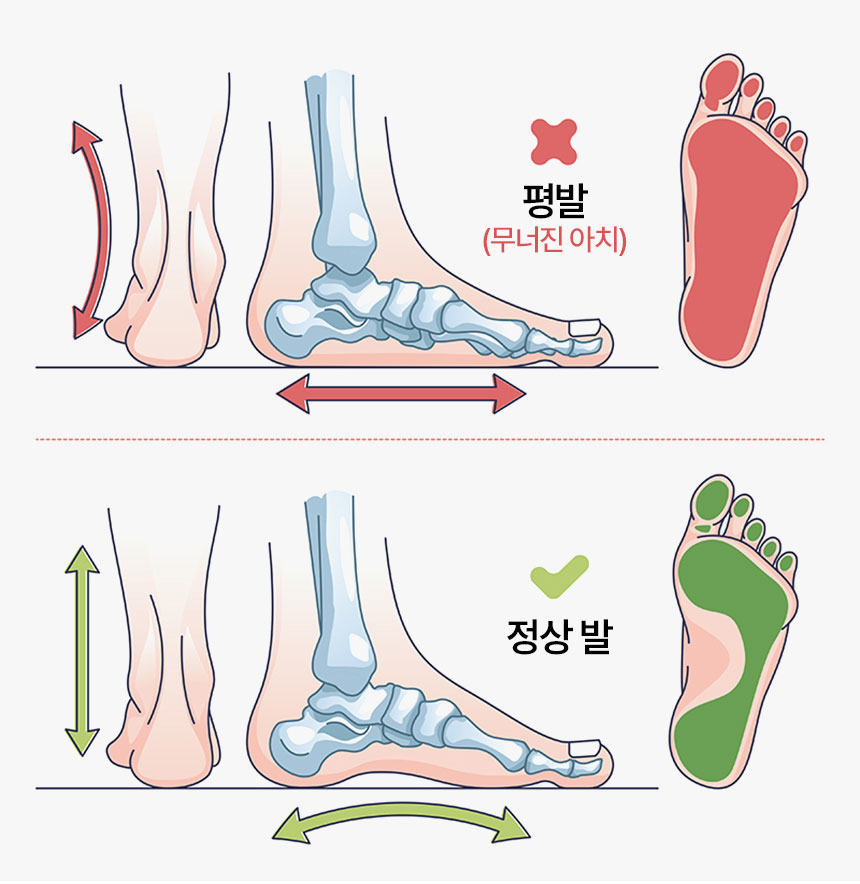 평발과 정상 발의 아치 차이 비교 이미지